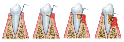 fogágybetgeség folyamata