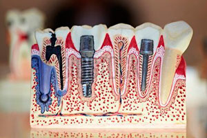 Impantáció titánium műgyökér